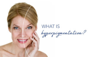 what is hyperpigmentation,hyperpigmentation,cause of hyperpigmentation,face hyperpigmentation,treatment for hyperpigmentation,hyperpigmentation on back,hyperpigmentation clinic