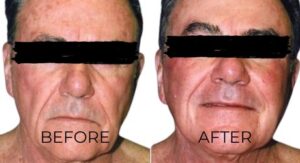 men's thread lifting before and after