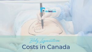 How Much is a Full Body Liposuction in Canada  (1)
