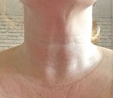 Neck Laser Genesis Before and after pictures 1